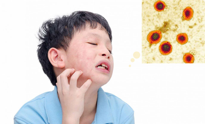 Trẻ mắc quai bị cần cách ly ít nhất 5 ngày kể từ khi bắt đầu sưng tuyến nước bọt