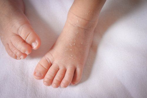 Trẻ bị khô da, ửng đỏ và ngứa ngáy sau khi tắm nước quá nóng