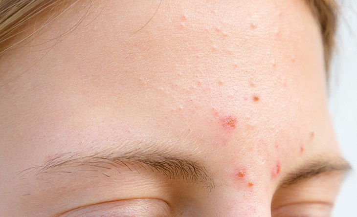 Mụn ẩn nổi nhiều sau treatment có thể là đẩy mụn hoặc dấu hiệu da bị kích ứng
