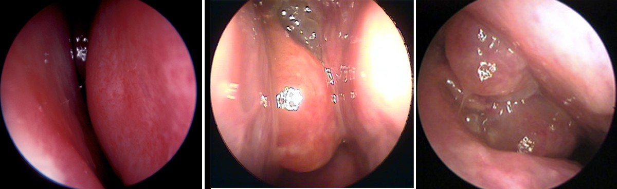 Phù nề niêm mạc mũi gây nghẹt mũi do giãn mạch và sung huyết cuốn mũi