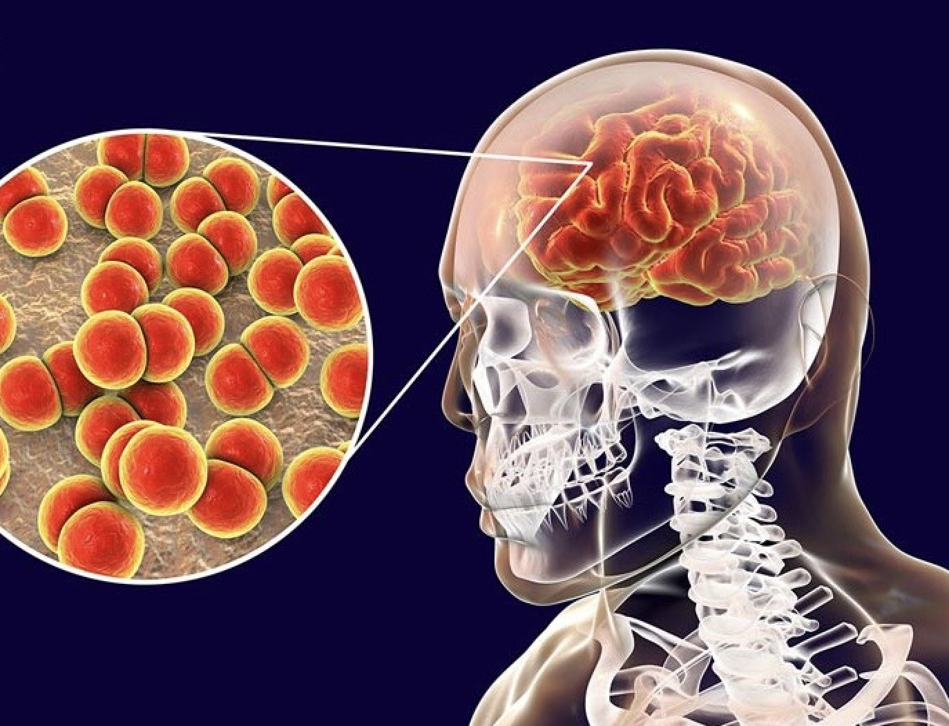 Viêm não mô cầu có triệu chứng dễ nhầm với cảm cúm thông thường