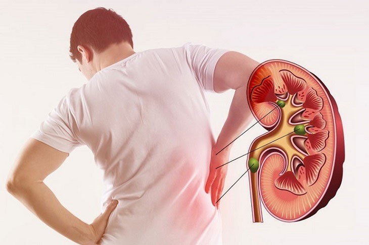 Táo bón làm tăng nguy cơ bị bệnh thận