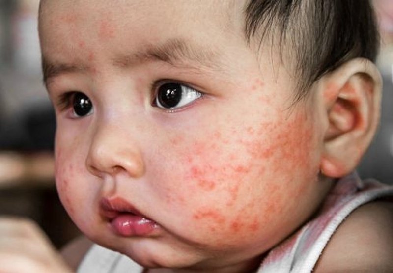 Trẻ bị chàm càng gãi càng ngứa do vòng xoắn ngứa và tổn thương hàng rào da