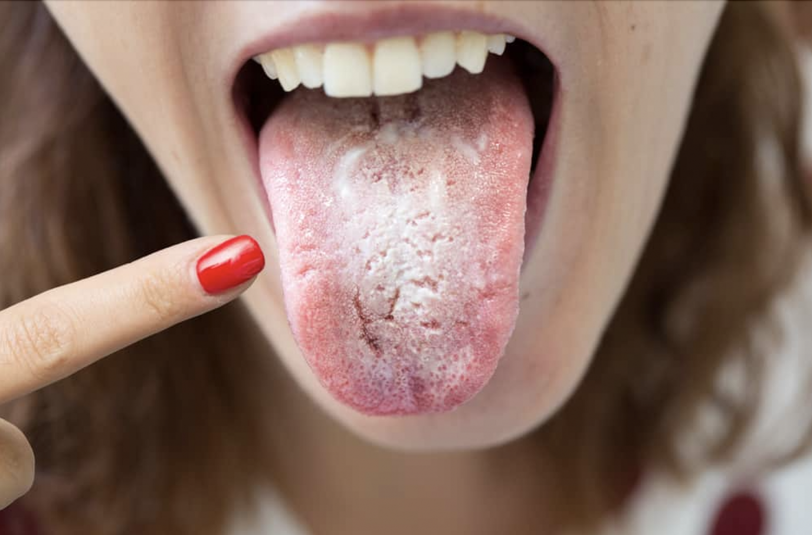 Phân biệt triệu chứng nhiễm nấm Candida với các bệnh lý thường gặp