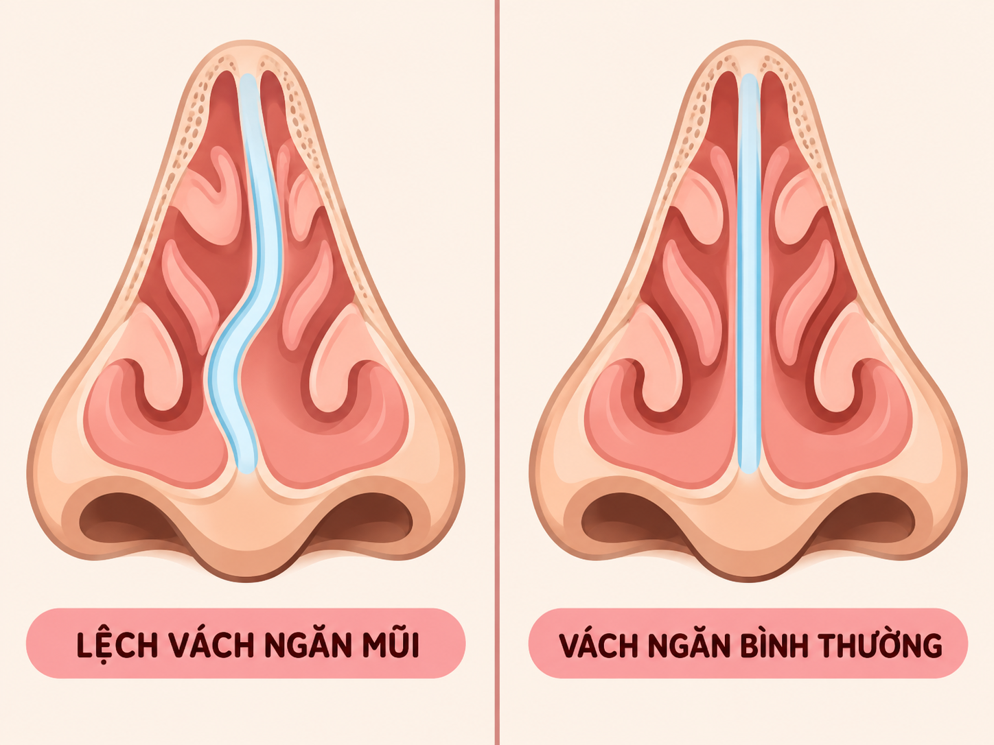 Vẹo vách ngăn có thể làm một bên đường thở bị hẹp và gây nghẹt mũi kéo dài