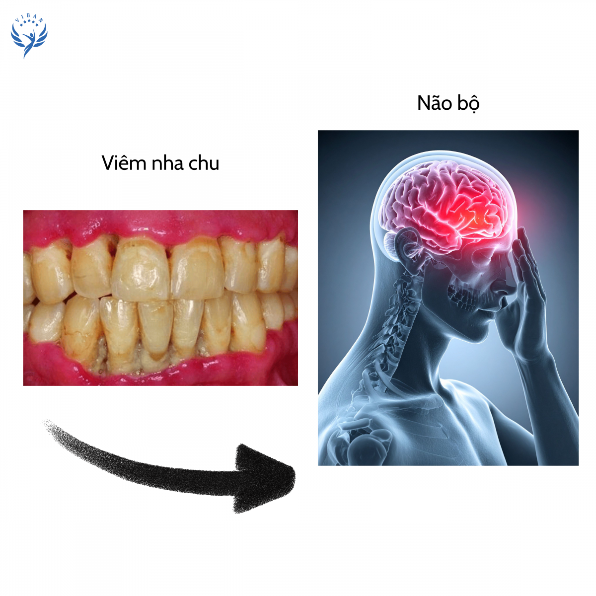Viêm nha chu ảnh hưởng đến chất trắng não và trí nhớ