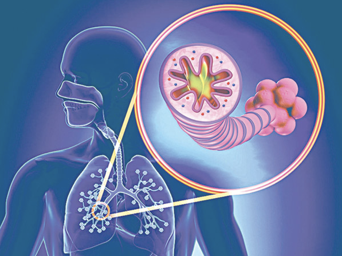 Virus cúm có thể làm tăng nguy cơ đợt cấp ở người bệnh phổi mạn tính